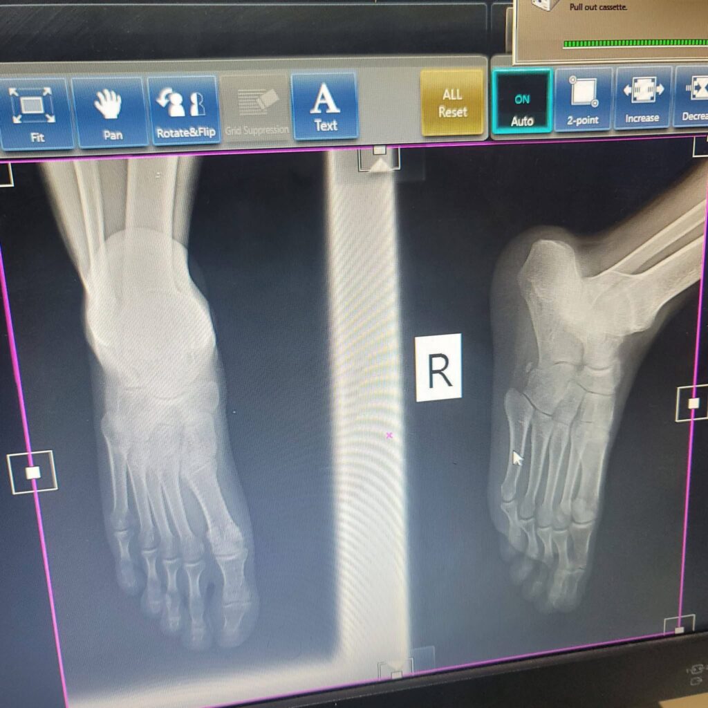 Dagorreti South MP John Kiarie on The Spot After Knocking Down a Boda Boda Rider And Fleeing, Leaving Him With Serious Injuries(Photos)